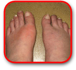 Gout Swollen Feet