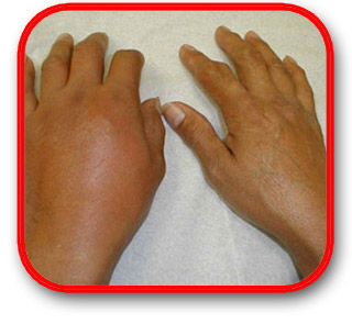 Gout Swollen Hand
