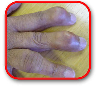 Gout Crooked Fingers